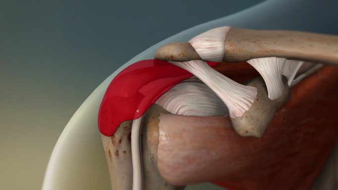BURSITIS