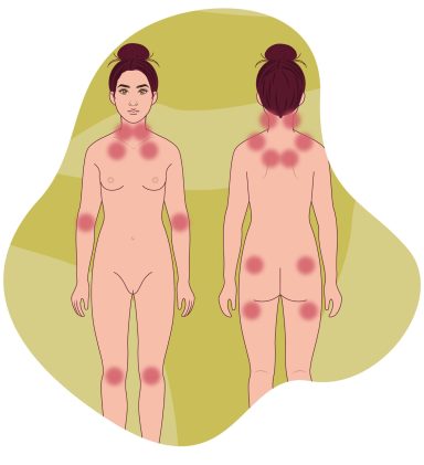 FIBROMIALGIA